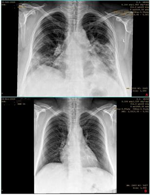 Beneficial Treatment Outcomes of Severe COVID-19 Patients Treated Entirely in Primary Care Settings With Dexamethasone Including Regimen—Case Series Report